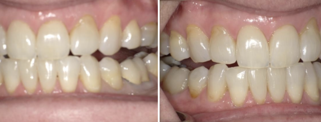 Posterior Open Bites, What Does it Mean?