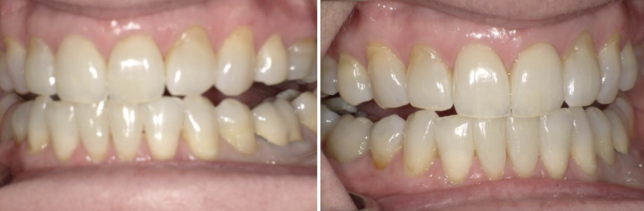 posterior-open-bite