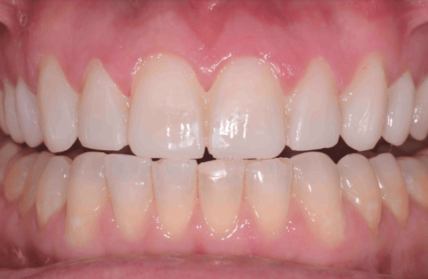 predictable-veneers