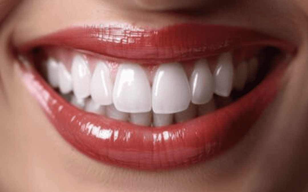 A Six-Unit Anterior Bridge: Provisionals and Placement