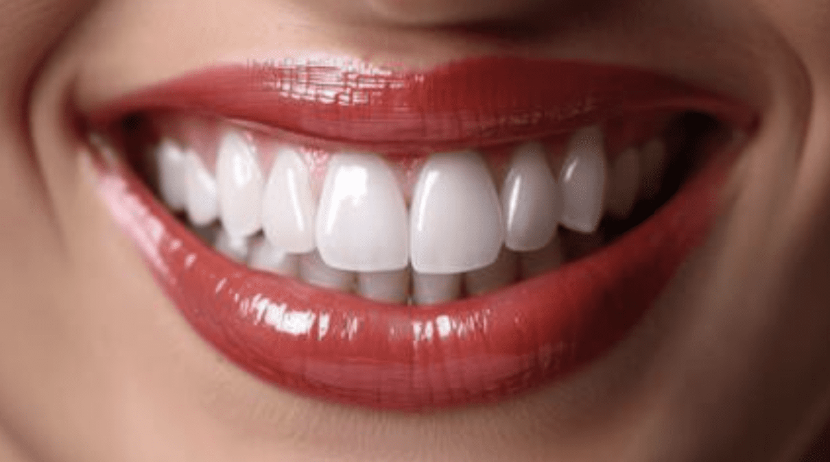 six-unit-anterior-bridge
