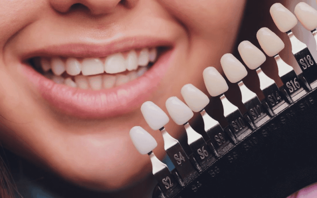Tips to Ensure Precision in Veneer Preparation