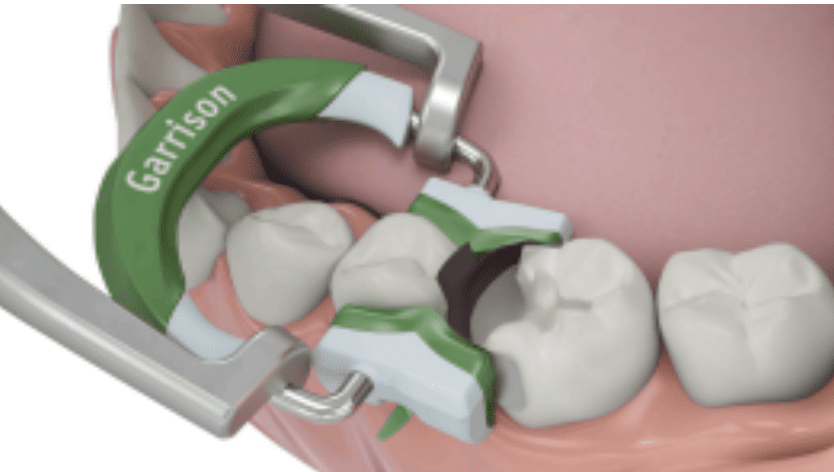 tofflemire-vs.-palodent
