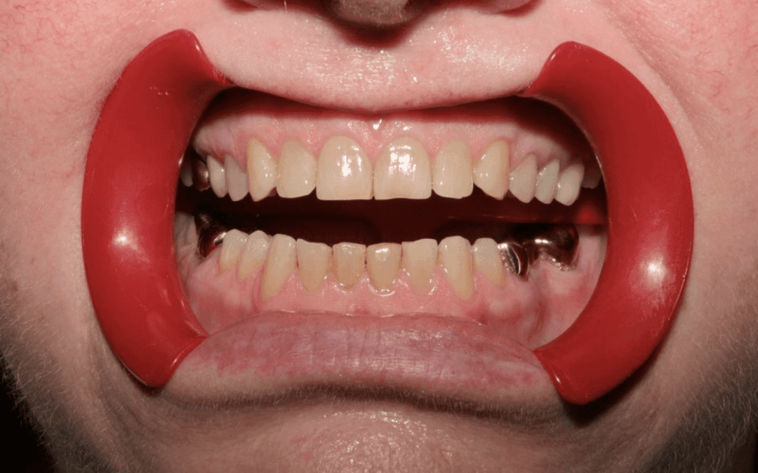 Unraveling the Etiology of Worn Teeth