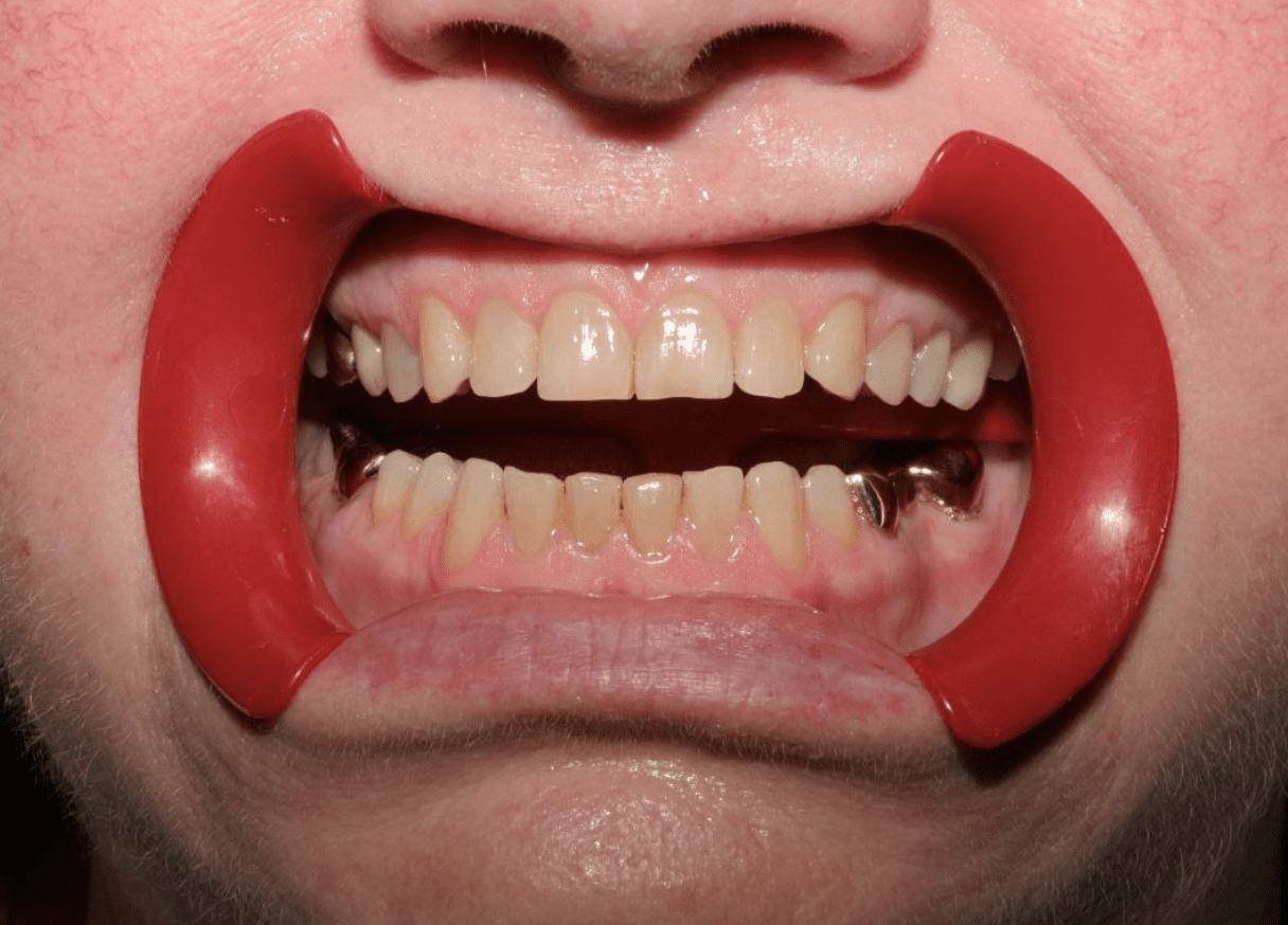 worn-teeth