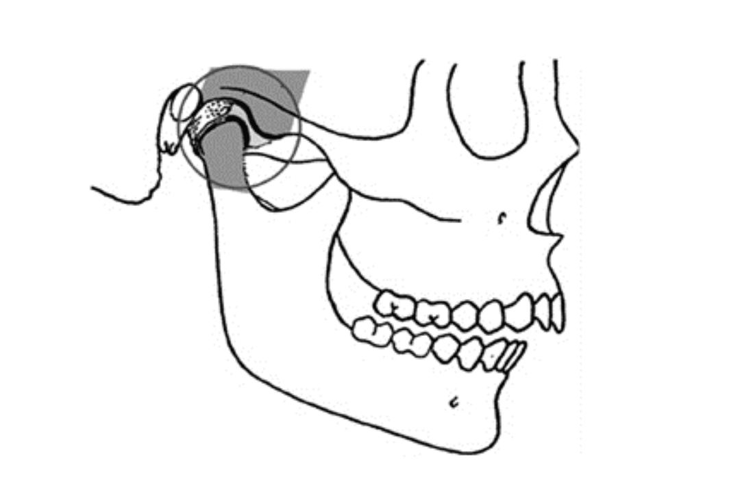 x-ray-image-showing-how-you-know-if-you-achieved-centric-relation
