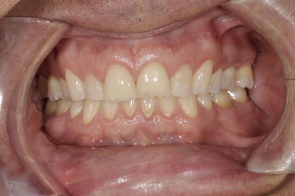 Retracted Closed Smile Controlling the Variables