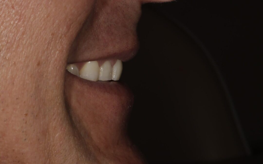 Incisal Edge Position
