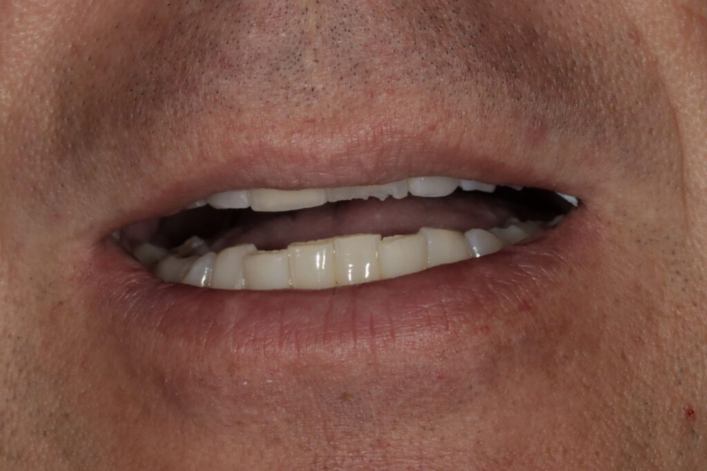 Rest Position Establishing Baseline Tooth Display