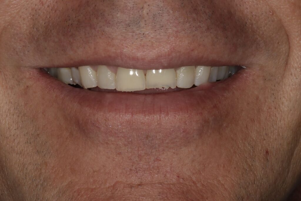 Full Smile Position Within the Vertical Envelope