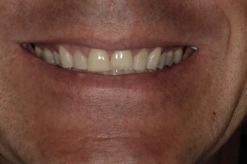 High Smile E Position Evaluating Maximum Expression