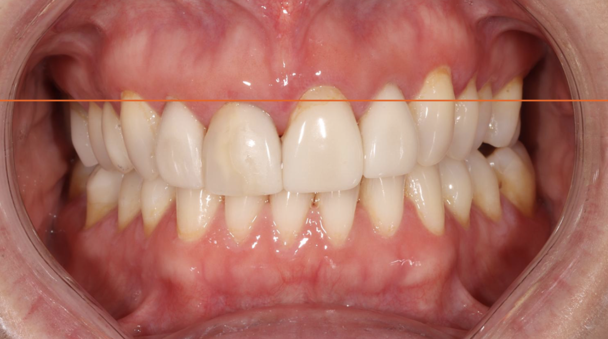 Assessing Gingival Position