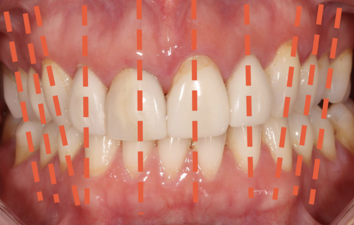 Axial Inclination and Tooth Angulation