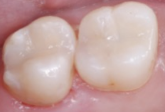 Pic 2 Final result with OMNICHROMA BLOCKER Flow and OMNICHROMA