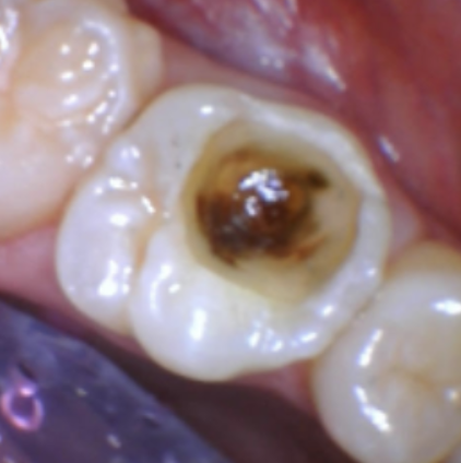Pic 4 Caries removal with detector dye Captured with intraoral camera