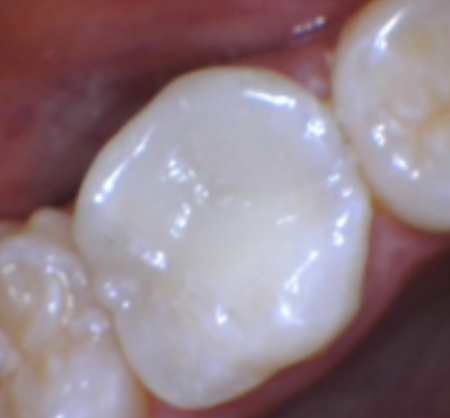 Pic 5 Final result with OMNICHROMA BLOCKER and OMNICHROMA
