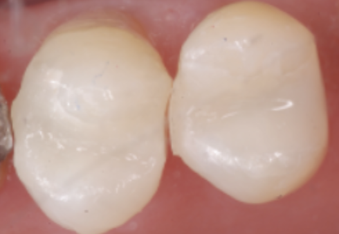 Pic 6 Uneven open proximal contacts Opportunity for self-critique and improvement