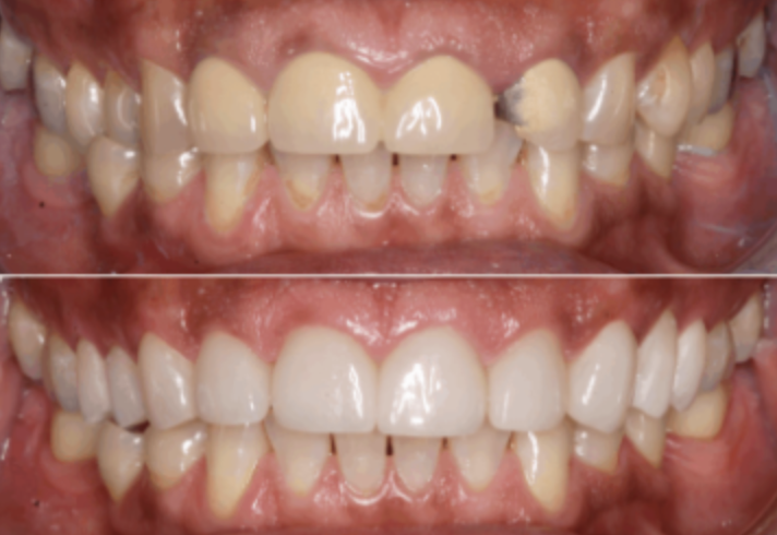 Pic 7 Full Upper Rehab with overlays and crowns currently on Invisalign Photography for marketing purposes and high return treatments
